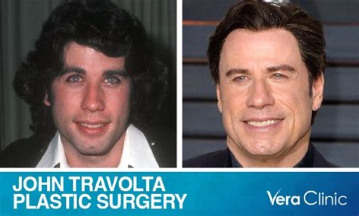 John Travolta's Plastic Surgery Journey Revealed
